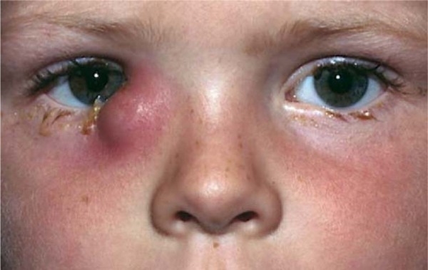 Дакриоцистит у взрослых – симптомы и лечение (фото)