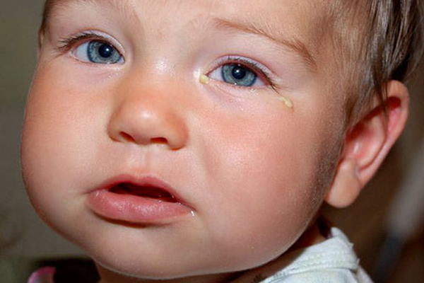 Дакриоцистит у детей – симптомы и лечение заболевания у ребенка