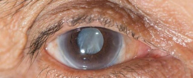 Лечится ли глаукома глаза, можно ли вылечить глаукому без операции