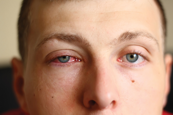 Аллергия на глазах – причины, симптомы, виды и как лечить (фото)