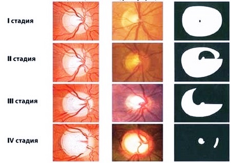 Атрофия глазного яблока — причины и симптомы (фото), можно ли вылечить