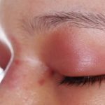 Покраснение вокруг глаз – причины и лечение