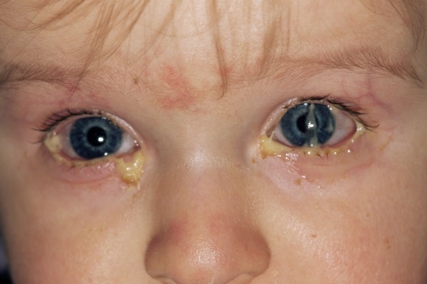 Бактериальный конъюнктивит у детей и взрослых — причины, симптомы и лечение