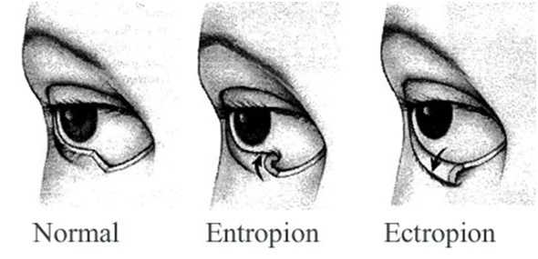 Заворот века у человека (энтропион) — причины, симптомы и лечение