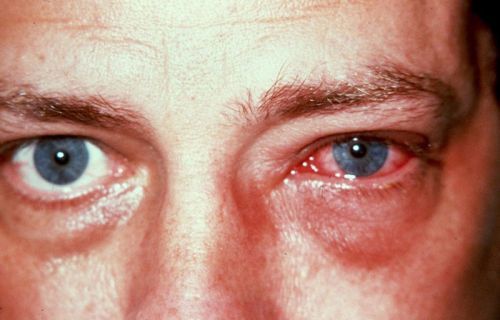 Ожог роговицы глаза – симптомы и лечение (фото). Химический ожог.