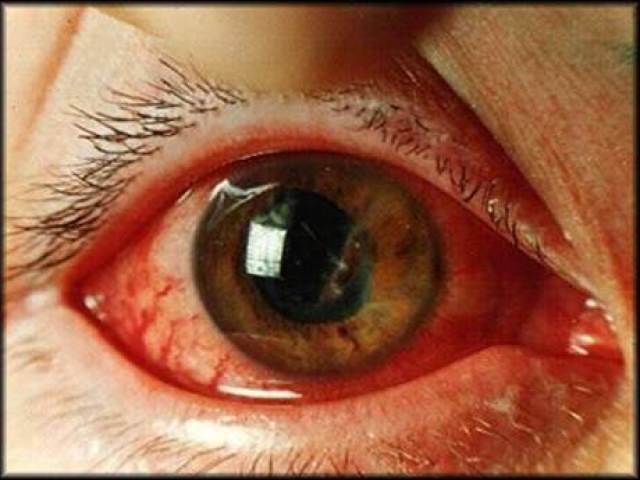 Кровоизлияние в склеру глаза – причины, симптомы и лечение