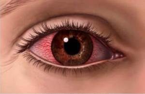 Ожог глаз от сварки: что делать и чем лечить